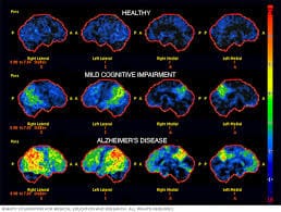 Alzheimer’s Disease Testing Market: Size, Share, and Industry Developments
