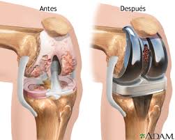 Knee Replacement Market Growth Supported by Aging Population and Joint Disorders