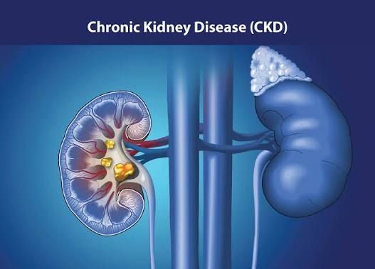 Chronic Kidney Disease Market Poised for Strong Growth Amid Rising Global Disease Burden
