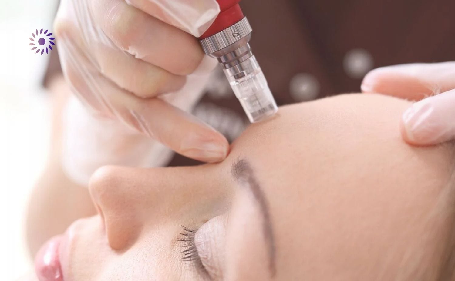 تجربة الميكرونيدلينغ في عيادة الدكتورة كرستين مدري في ألمانيا