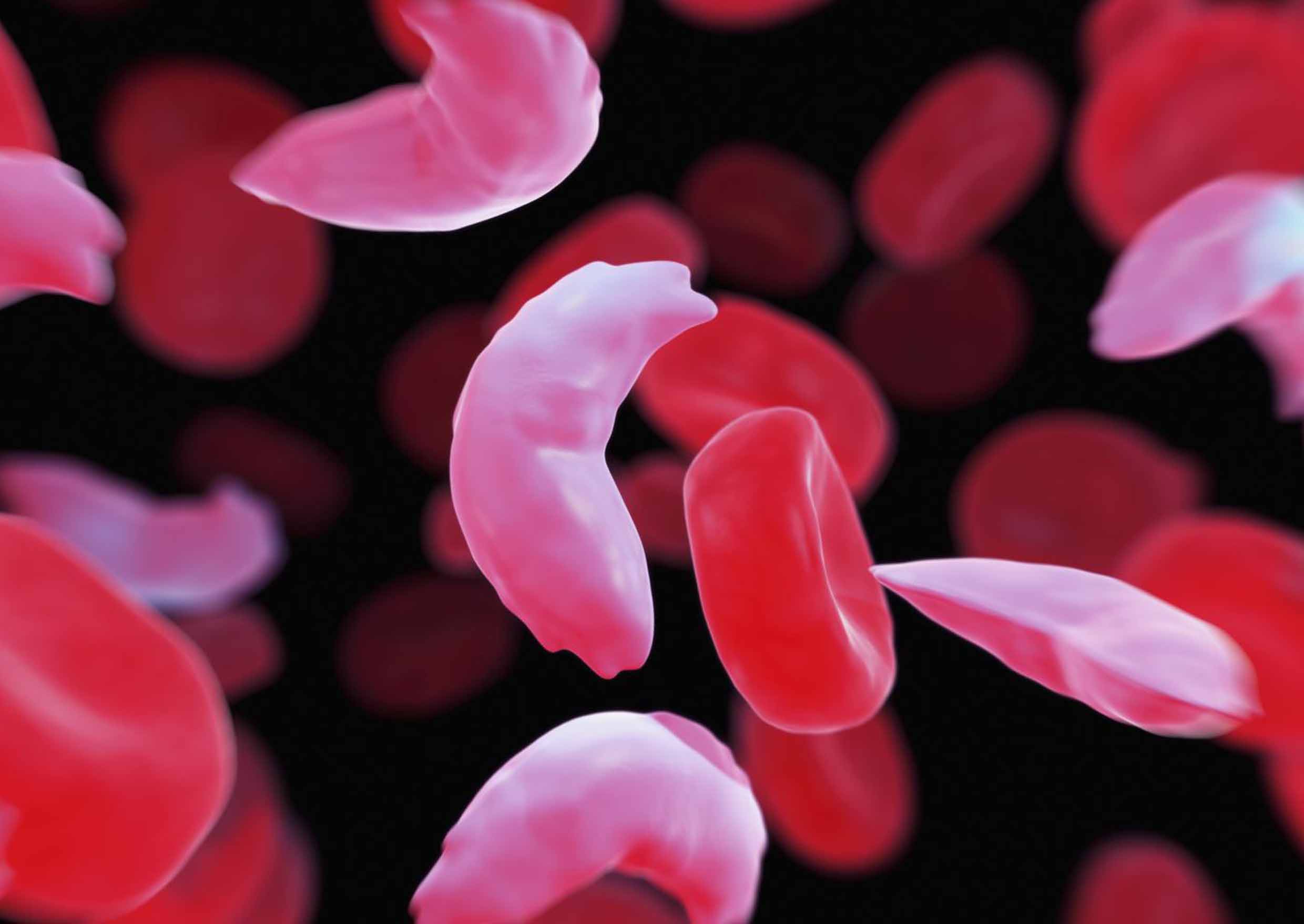 What Is Sickle Cell Disease SCD, Myths, And Truths?