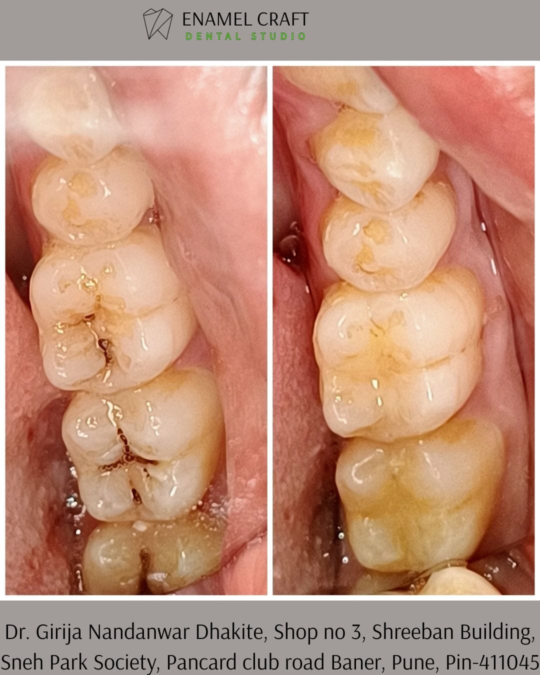 Dental Myth vs Truth- Dentist in Pancard club road, Baner, Pune.