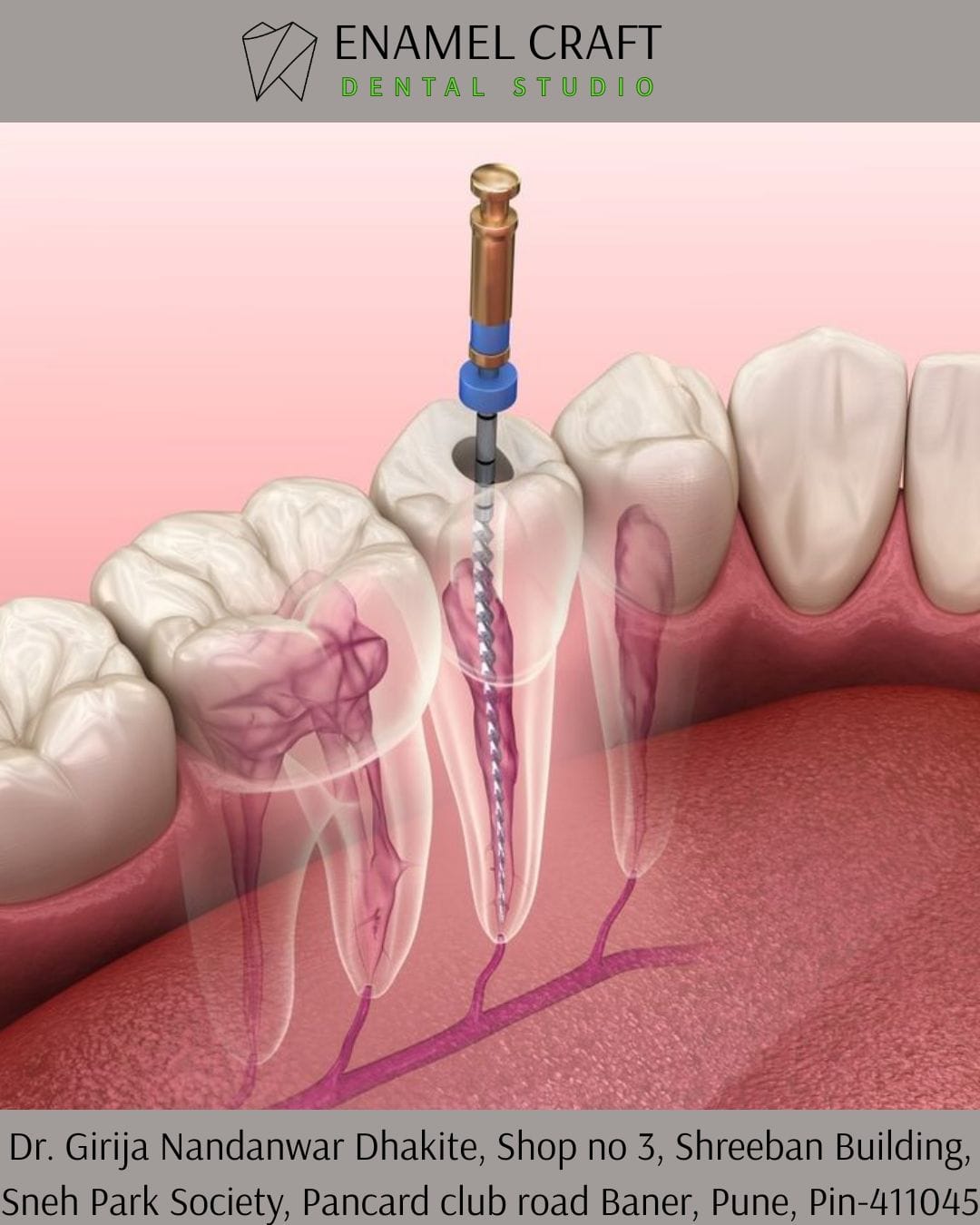 Single Visit Root Canal treatment – Dentist in Pancard club road, Baner, Pune.