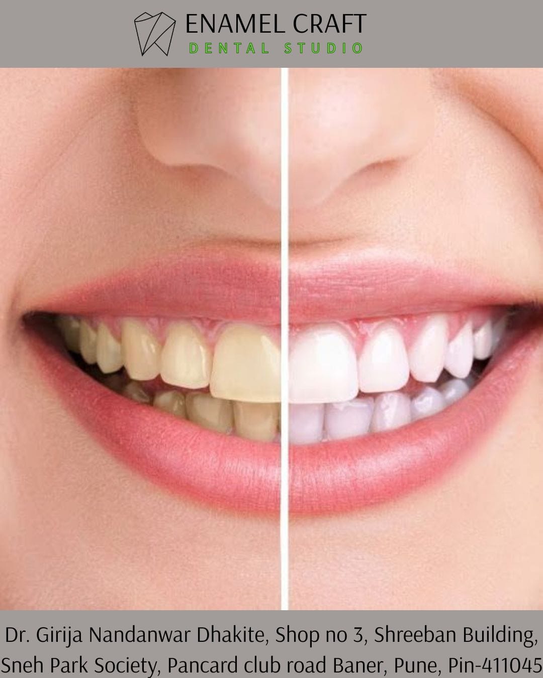 Dental myth busted, teeth whitening facts- Dentist in Pancard club road, Baner, Pune.