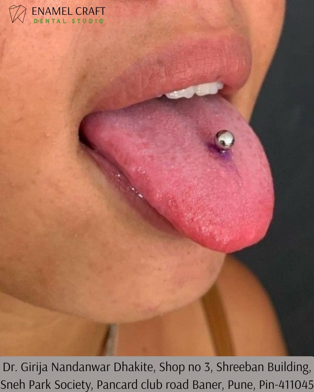 Tongue Piercings Can Damage More Than You Think- Dentist in Pancard Club road, Baner, Pune.