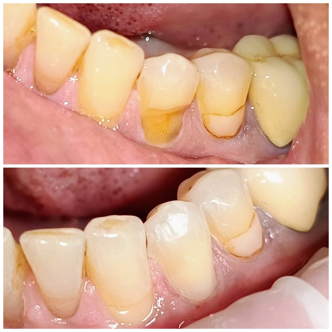Composite Restoration in Pancard club road, Baner, Pune.