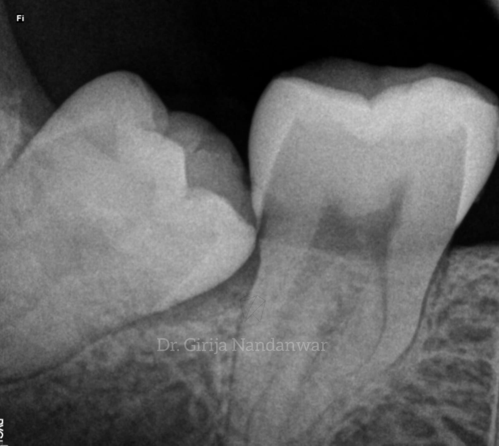 Wisdom tooth Extraction in Pancard club road, Baner, Pune.