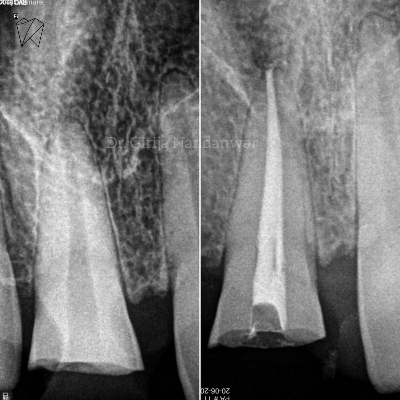 Painless Root Canal Treatment in Pancard club road,  Baner, Pune