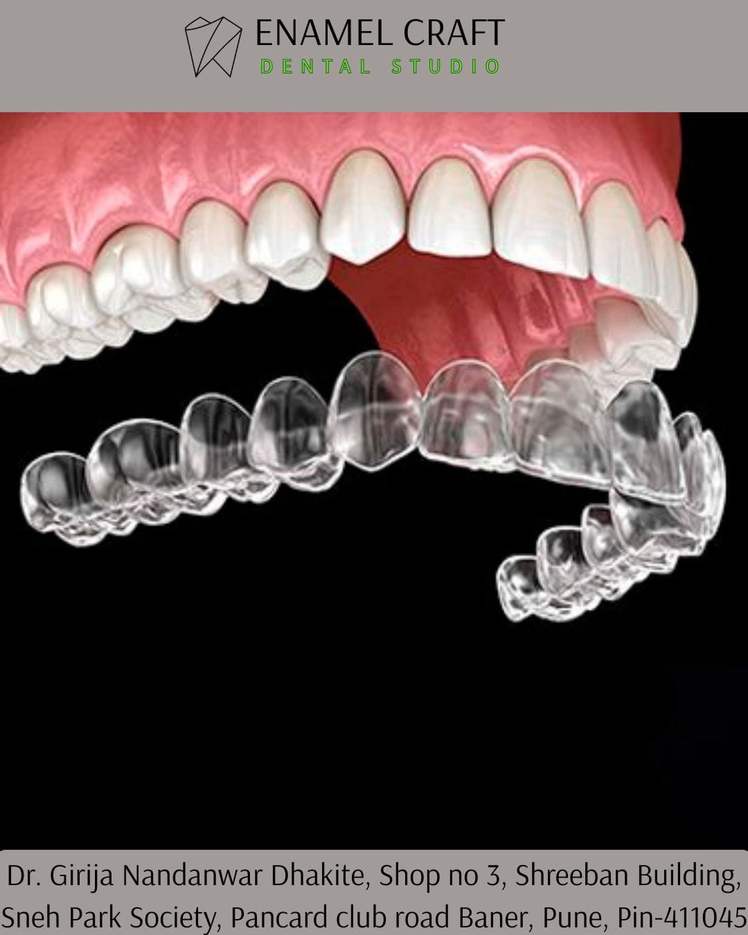 Teeth Aligners- Modern Braces for Adults Dentist in Pan card club road, Baner, Pune.