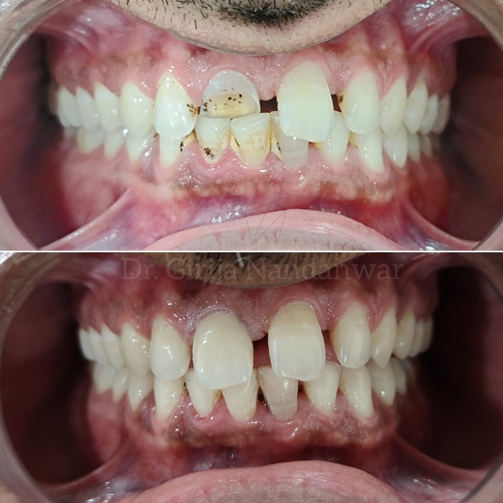 Tooth Fracture Restored with Zirconia Crown in Baner, Pune.