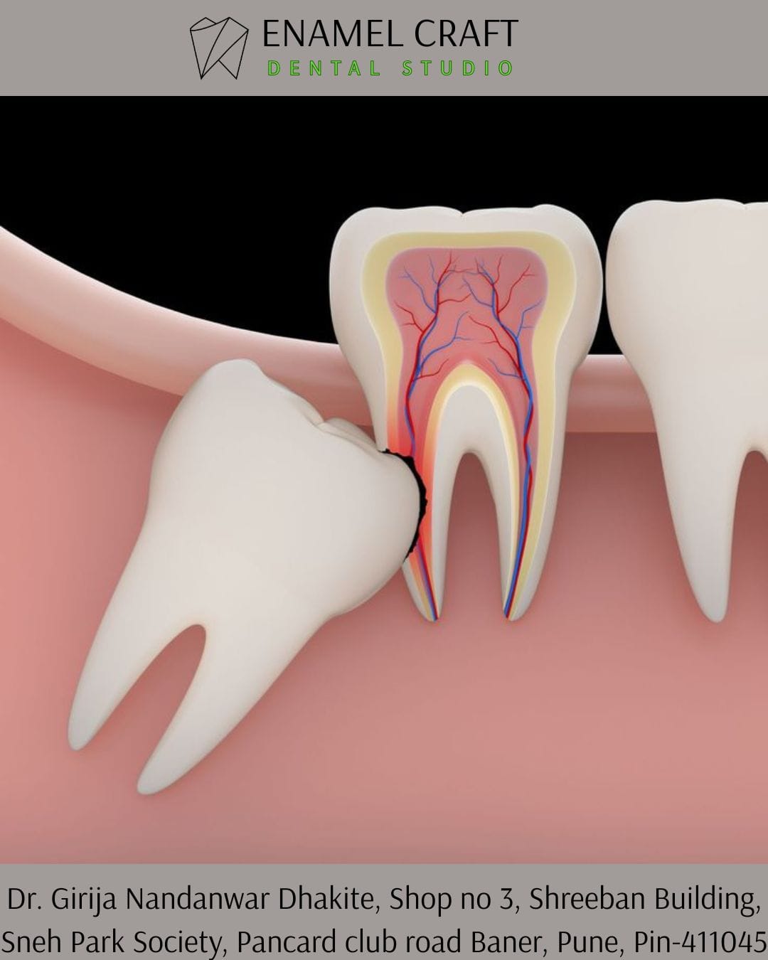 When to consider Wisdom Tooth Removal- Dentist in Pancard club road, Baner, Pune.