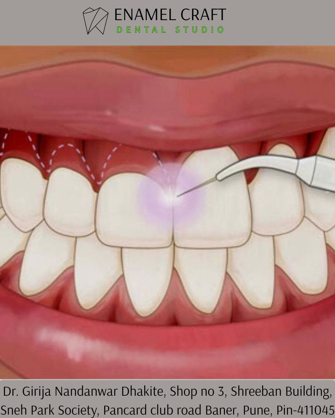 Crown Lengthening Treatment inPancard club road, Baner