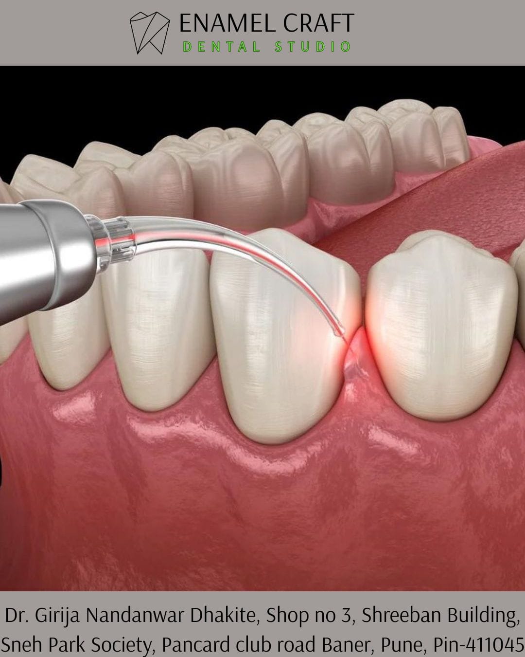 Laser Dentistry in Pancard Club road, Baner, Pune. (Copy)
