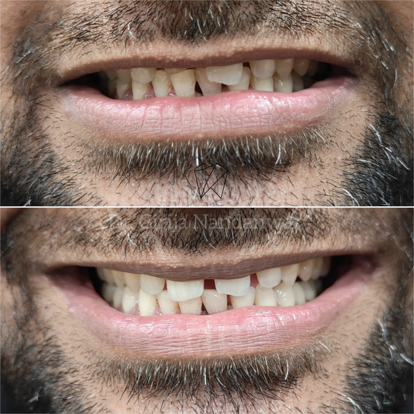 Full Mouth Rehabilitation by Dr. Girija – Best Dentist in Baner
