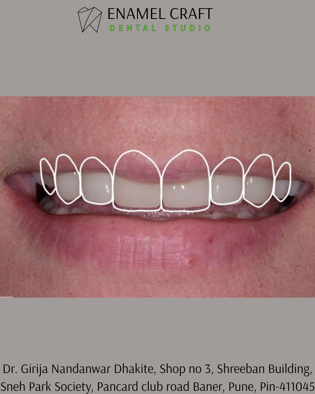 Digital Smile Design – The Future of Smile Makeovers in Baner