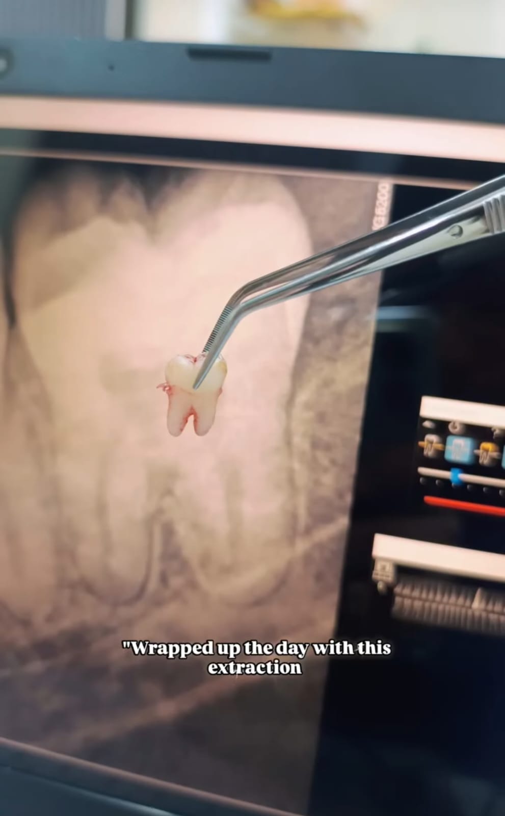 Wisdom Tooth Extraction in Baner – When and Why Is It Needed?