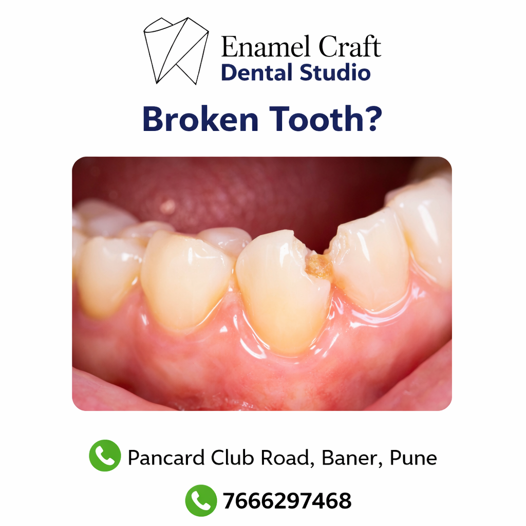 Broken Tooth Treatment in Baner, Pune | Expert Dental Care