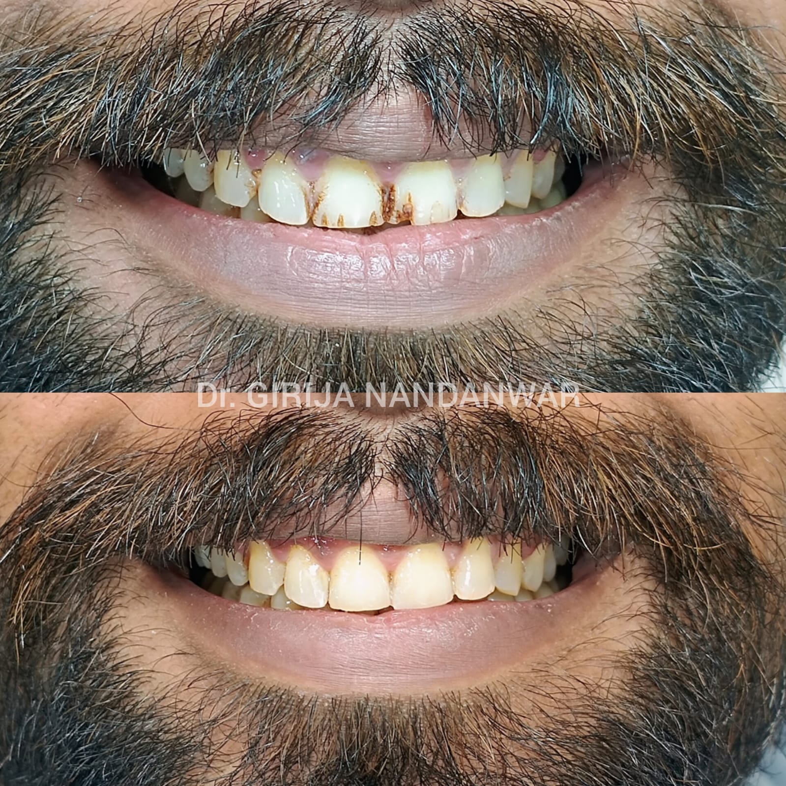 Smile Transformation with Composite Restoration in Baner, Pune