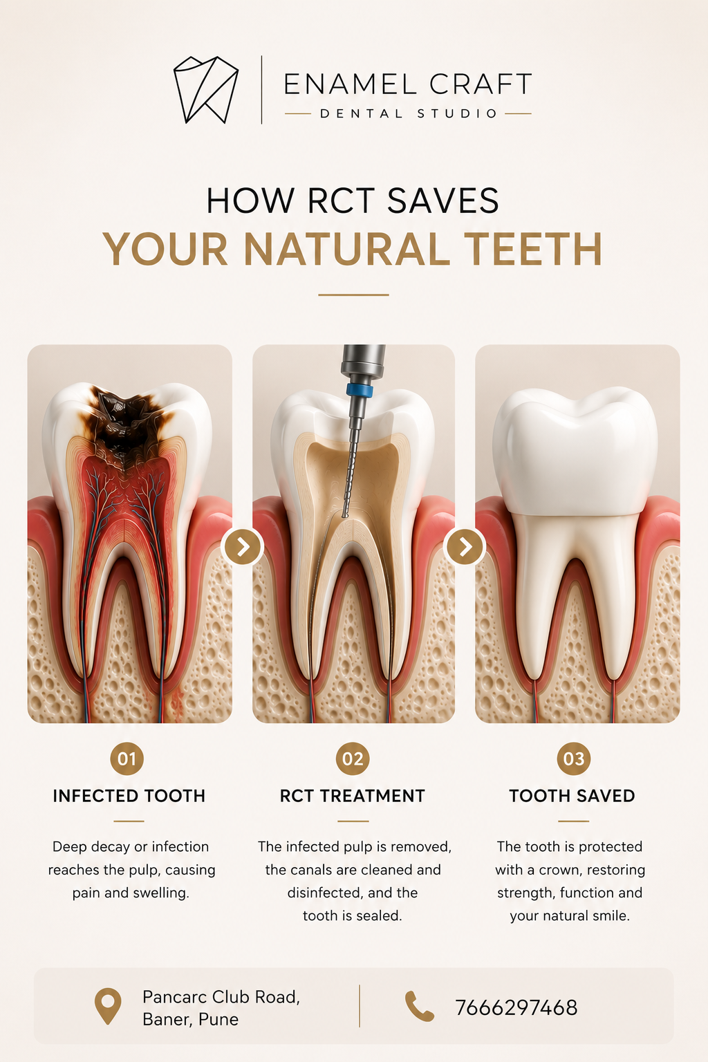 How Root Canal Treatment (RCT) Saves Your Natural Teeth