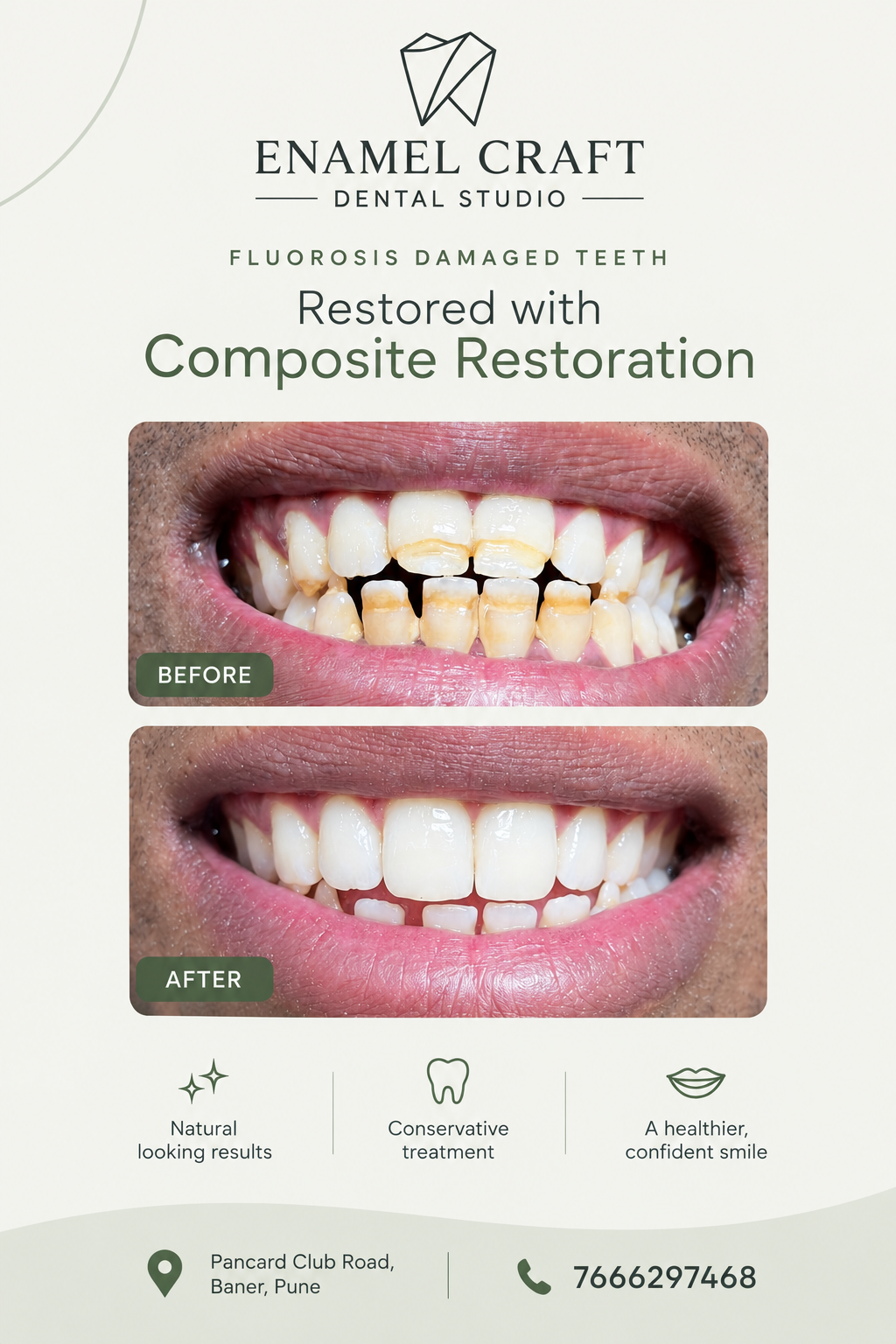 Fluorosis Treatment with Natural-Looking Composite Restoration