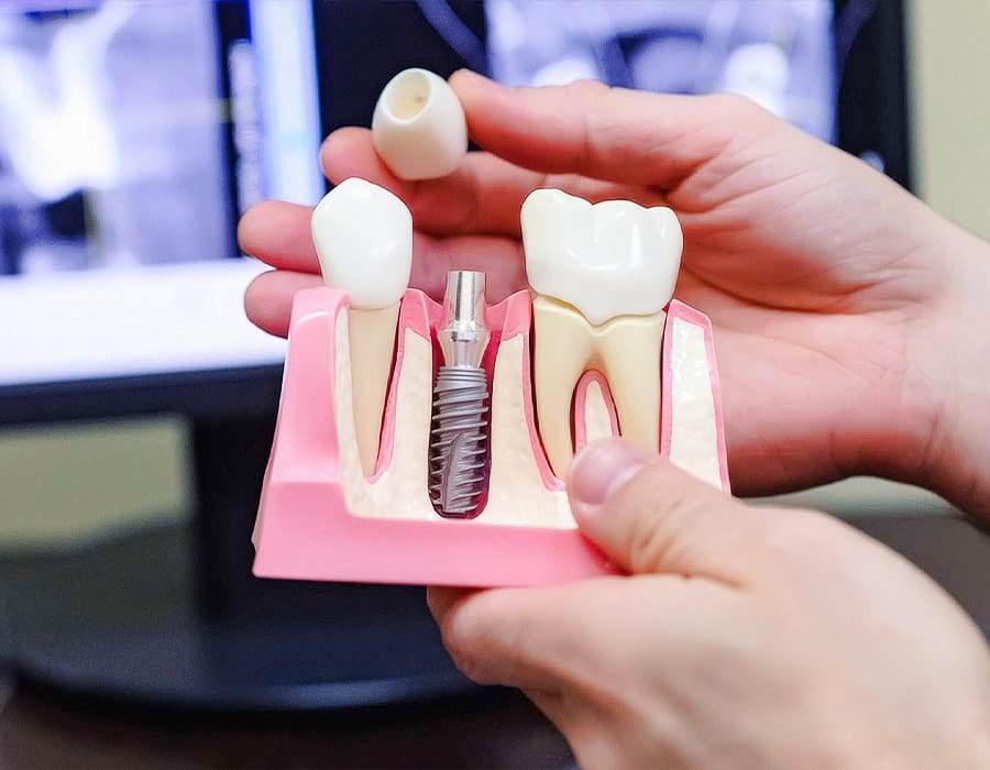 Romania Dental Implants Market Size, Status and Forecast by 2031