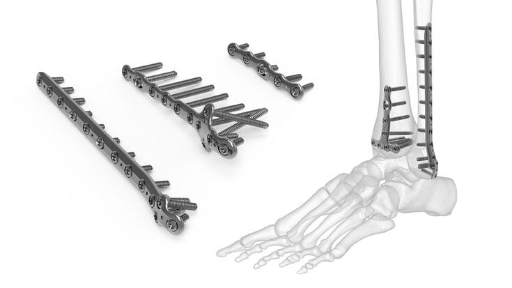 Pediatric Orthopedic Implants Market: A Growing Demand